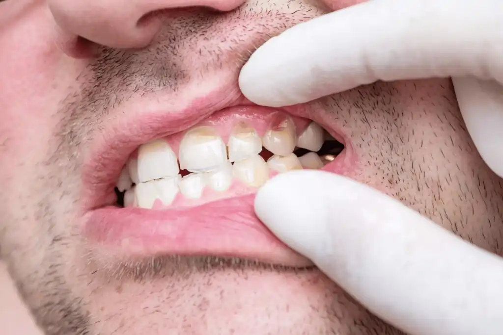 Could My Everyday Habits Be Slowly Damaging My Tooth Enamel Without Me Knowing Warwickshire